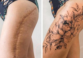 The Transformation of Scars Into Beautiful Tattoos