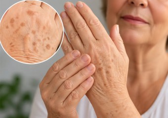 Make Age Spots A Thing Of The Past — People Are Ditching Expensive Creams For This Simple Dark Spot Trick