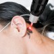 The Most Asked Questions About Laser Tattoo Removal